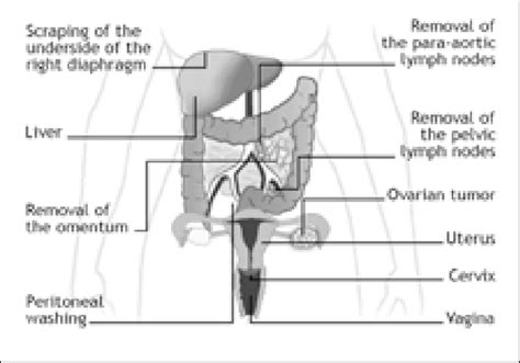 Ovarian cancer is a cancer that forms in or on an ovary. Procedures Required for Surgical Staging of Ovarian Cancer ...