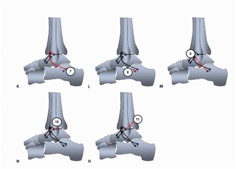 Lateral Ankle Ligament Reconstruction Using Allograft And Interference