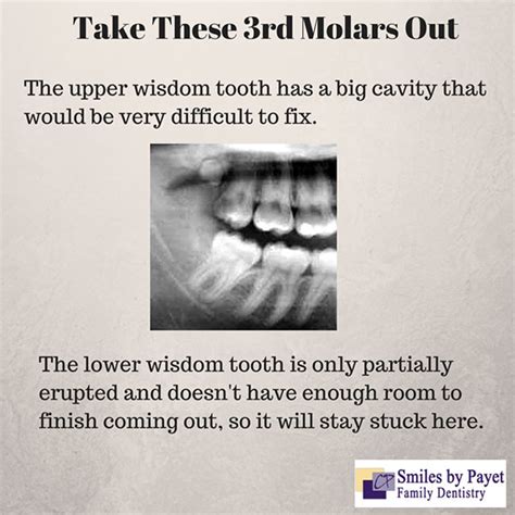 Wisdom teeth are often removed because they either don't fully erupt from the gums or don't erupt at all. Oral Surgery | Charlotte Dentist | Wisdom Teeth ...