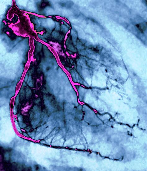 Narrowed Coronary Arteries Photograph By Zephyrscience Photo Library