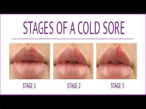 Cold Sores On Lip Early Stage Youtube