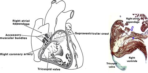 Anatomy Of The Atrioventricular Junction Atrioventricular Grooves And