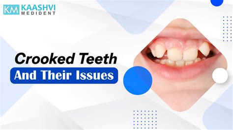 Crooked Teeth And Their Issues