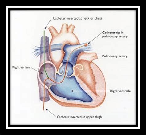 right heart catheterization