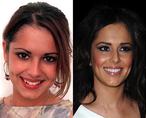 Celeb Teeth Before And After Xclusive Touch Celebrity Teeth