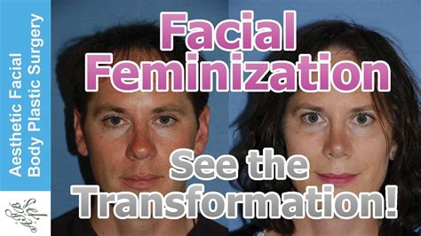 Transgender Facial Feminization Ffs Mtf M F Plastic Surgery Video By