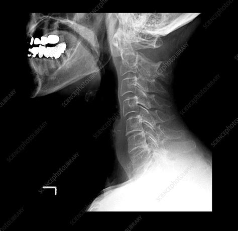 Severe Fracture Of The Cervical Vertebrae Stock Image M3301253