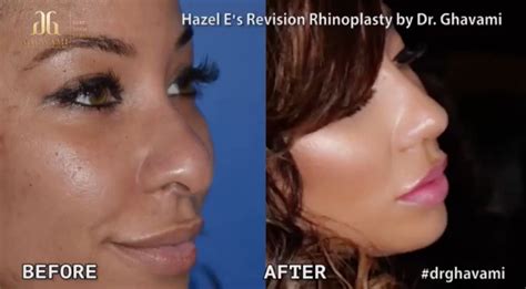 Hazel E Before And After Plastic Surgery Nose Job