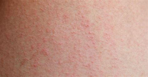 Eczema Also Called Atopic Dermatitis Is A Chronic Condition That