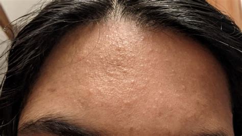 Skin Concerns Any Idea What These Forehead Bumps Are R
