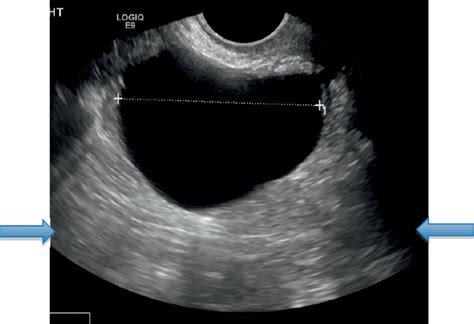 Chapter 8 Sonographic Assessment Of Ovarian Cysts And Masses Obgyn Key