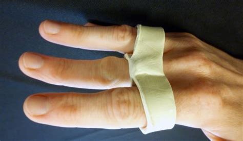 Using A Relative Motion Orthosis When Treating A Boutonniere Injury