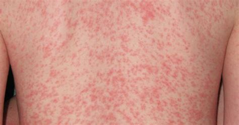 Although it can also be caused by chafing and skin sensitivity. Adult Heat Rash | Heat Rash | Pinterest | Heat rash