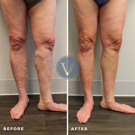 Treatment For Varicose Veins Causing Leg Pain The Vein Institute