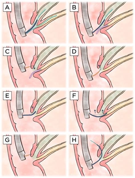 Illustration Of Various Advanced Common Bile Duct Cannulation