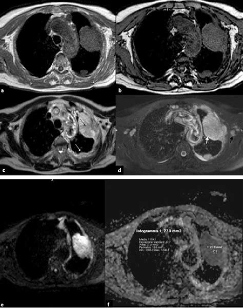 Malignant Pleural Mesothelioma Axial T1 Weighted Mr Images Showing A