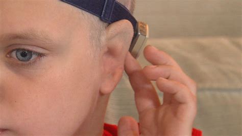 Boy Born Without Ears Undergoes Rare Surgery Video Abc News