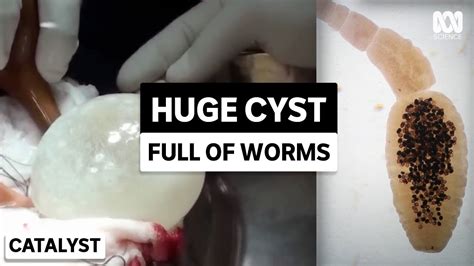Removing Massive Brain Cyst Caused By Tapeworms Youtube