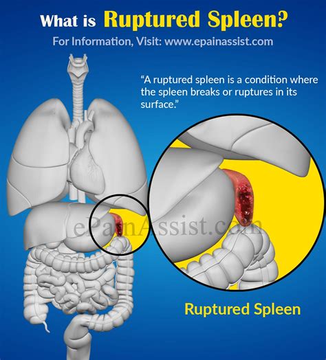 Enlarged Spleen Causes