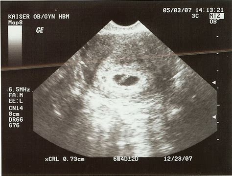 6 Weeks Ultrasound Hiccups Pregnancy