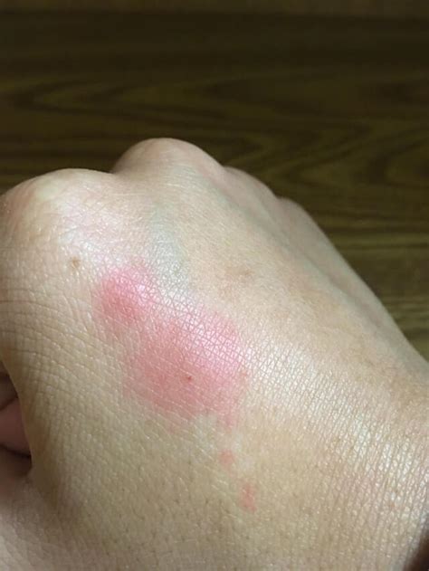 They'll also be simple red bumps without any pus or fluid. Chigger bites vs bed bug bites: Identify bug bite ...