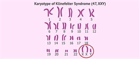 Karyotype Of Klinefelter Syndrome