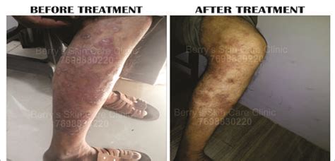 Legs Psoriasis Treatment Treatment For Legs Psoriasis Berry Skin Care