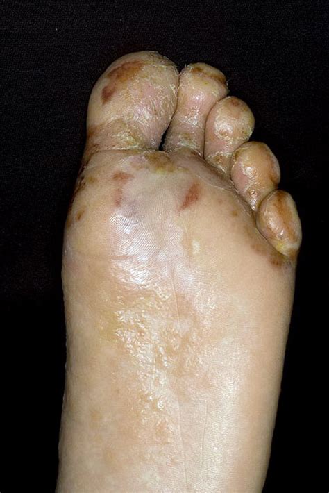 Dyshidrosis Foot Pictures 18 Photos And Images