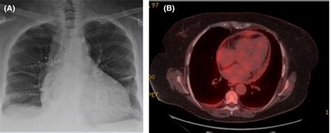 A Chest X‐ray Showing Cardiomegaly B Moderate Uptake In The Pleura