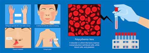 Polycythemia Vera Cause Stages Symptoms Treatments Page 2 Of 2