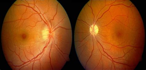Fundus Picture Of Both Eyes Showed Optic Disc Edema In The Right Eye