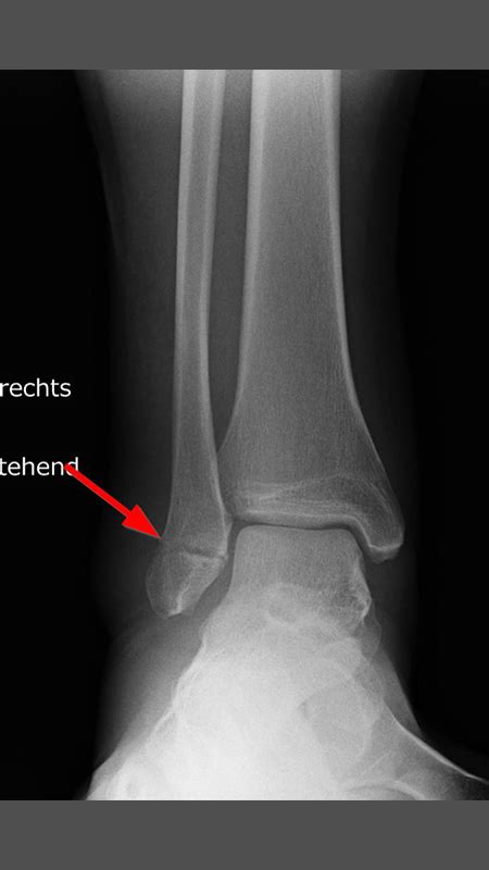 Viele orthopädische und unfallchirurgische krankheitsbilder erfordern eine operative behandlung. Sprunggelenkfraktur - OGAM Orthopädie