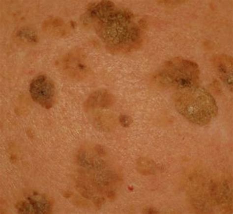 Seborrheic Keratosis Pictures Symptoms Treatment Removal And 11520