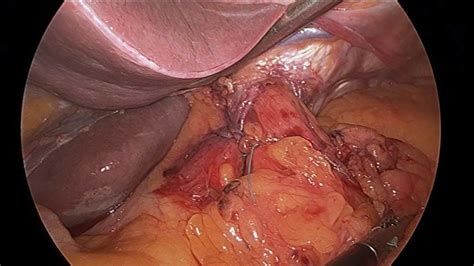 Hiatal Hernia Repair Reflux And Adjustable Gastric Band Revision