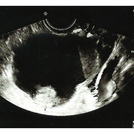 Pelvic Ultrasound Ovarian Cysts