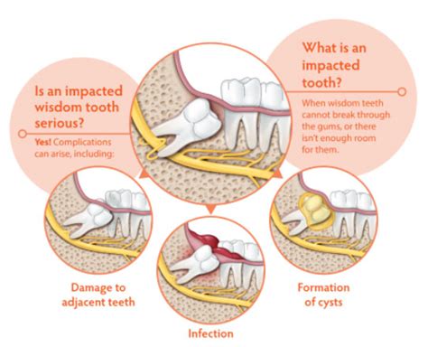 Typical cost ranges for wisdom tooth removal the cost of the surgery depends on how complex the tooth removal is. 3rd Molar Extractions - Wisdom Teeth Removal - Cost and ...
