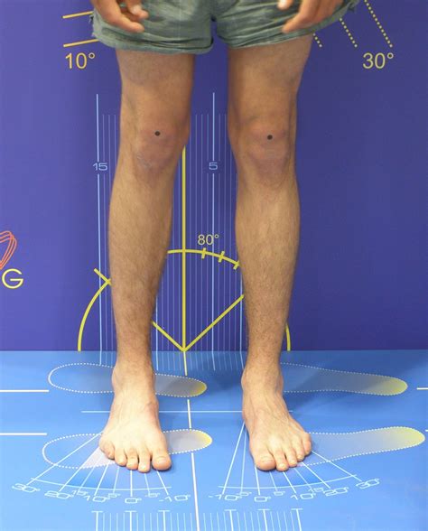 Nein, schmerzen im knie treten genau so auch bei langjährigen läufern auf, die ursachen dafür können sehr vielseitig sein. www.kid-check.de