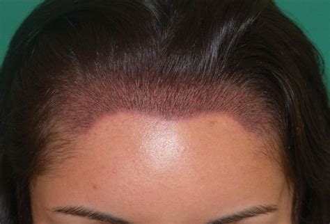 2161 Graft Female Hairline Restoration Hair Loss Surgery Before And
