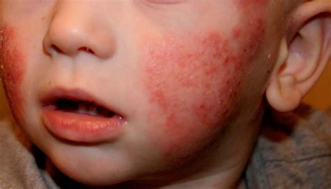 O Que é Dermatite Atópica Em Bebê Livros