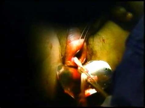 If you think you may be pregnant and are considering abortion. How to do an abortion yourself? | Yahoo Answers