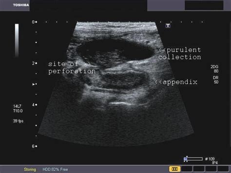 Perforated Appendix Or Appendiceal Perforation Medical Ultrasound