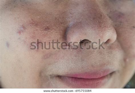 Acne On Facial Skindermatological Disease Acne Stock Photo 695755084