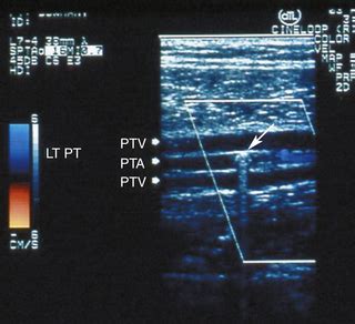 Ultrasound Assessment Of Lower Extremity Arteries Radiology Key