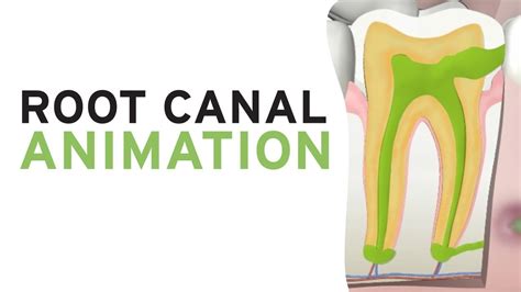 Root Canal Treatment RCT Step By Step Animation Dental Clinic