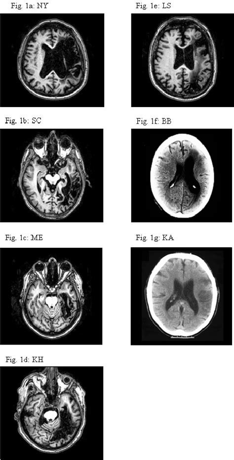 Neuroimaging For The Stroke Aphasic Patients Download Scientific Diagram