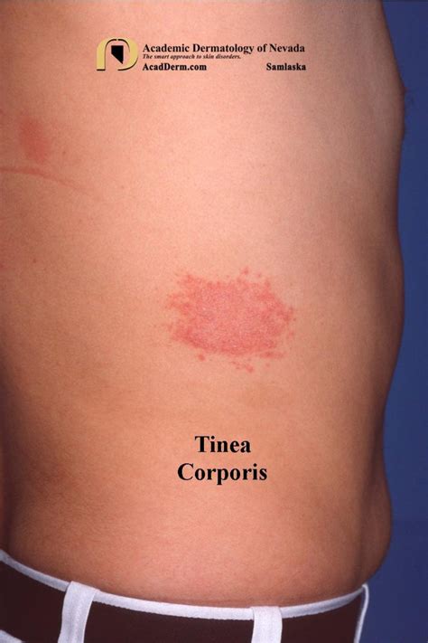 Tinea Corporis Ringworm Tinea Circinata Academic Dermatology Of