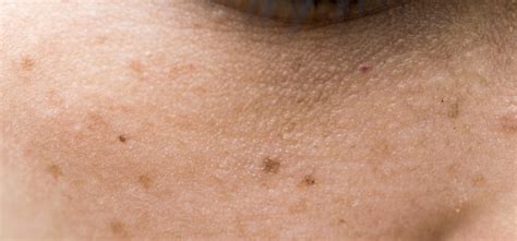 How To Remove Freckles Different Treatments And Their Cost