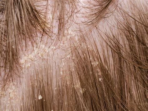 Dandruff Caused By Fungal Infection Dry Scalp Treatment Dry Scalp