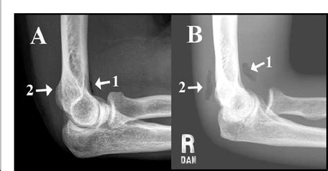 Figure 1 From Fat Pad Signs In Elbow Trauma Semantic Scholar