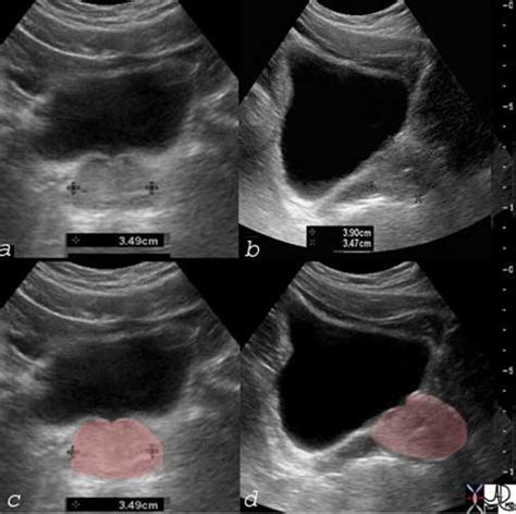 Prostate Ultrasound Anatomy